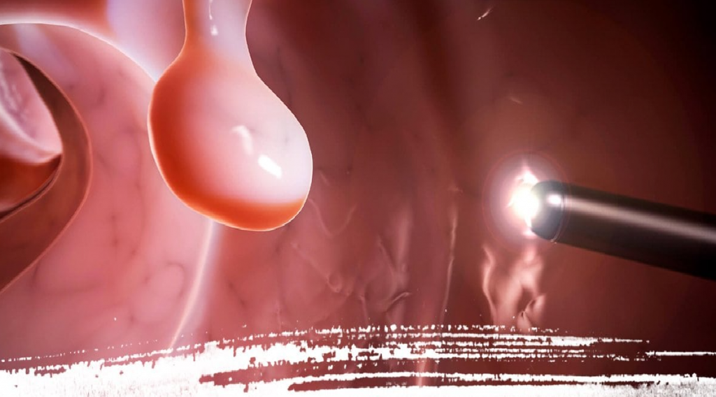 Miomi e polipi – Centro Demetra